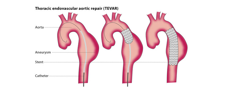Thoracic Endovascular Aortic Repair
