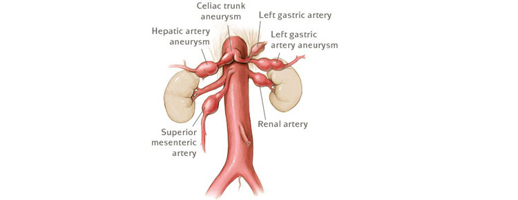 Visceral Artery Aneurysm