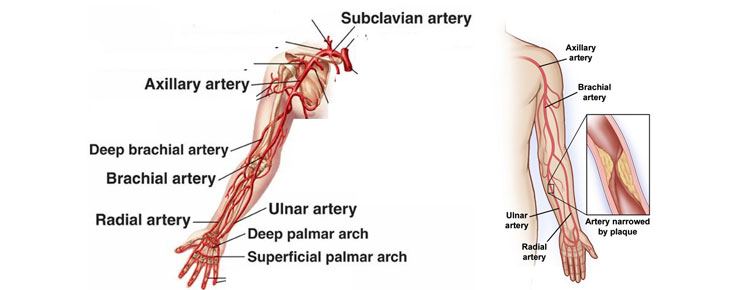 Arm Artery Disease