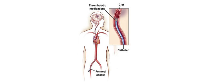 Catheter-Directed Thrombolytic Therapy