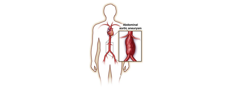 Endovascular Repair of Abdominal Aortic Aneurysms