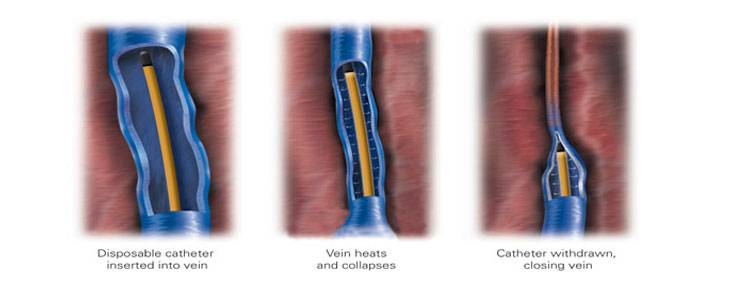 Venefit™ Targeted Endovenous Therapy